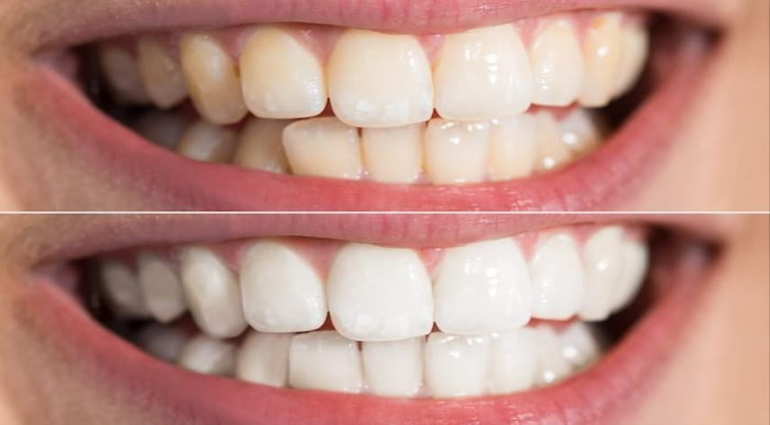 are yellow teeth healthy