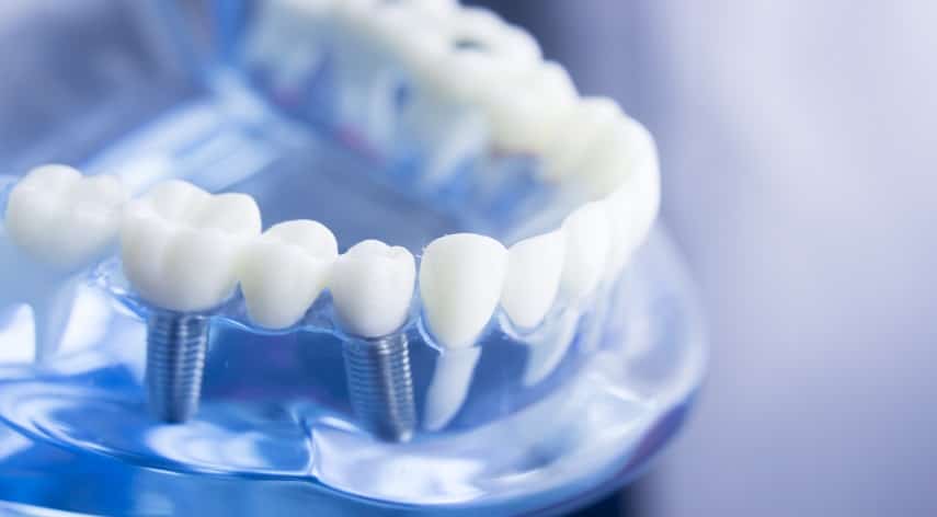 benefits of dental implants