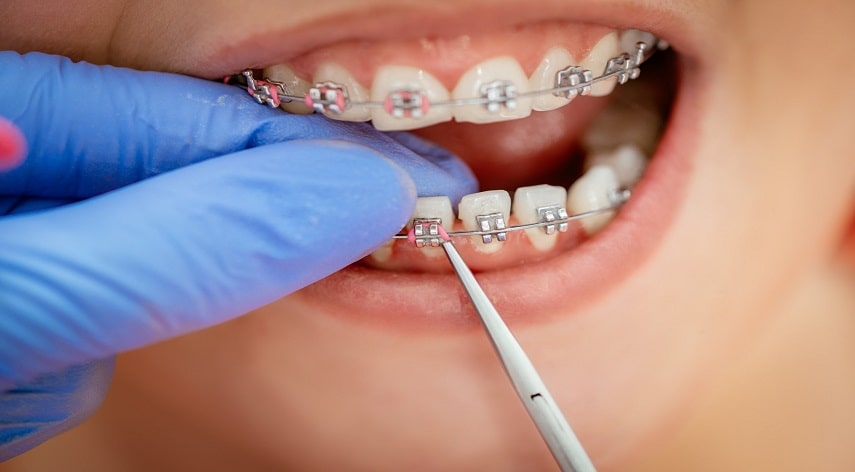 best age for braces