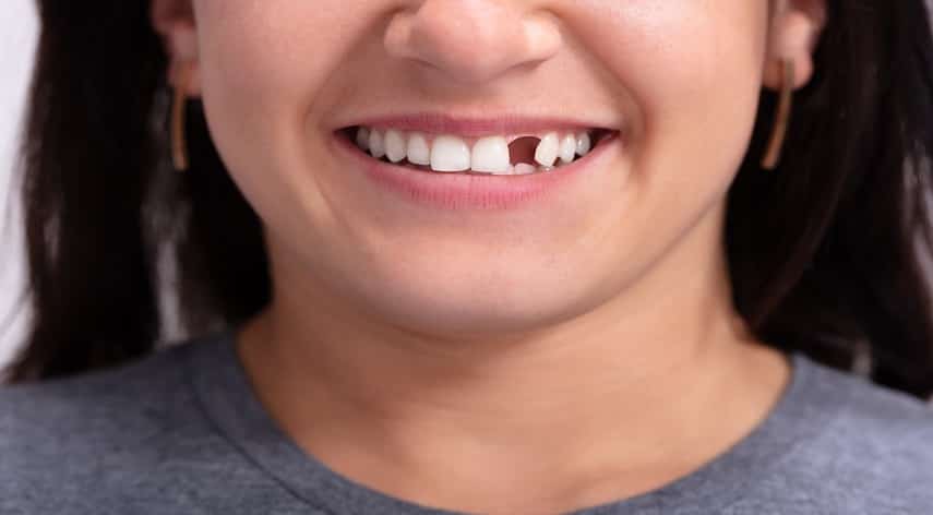 complete teeth replacement