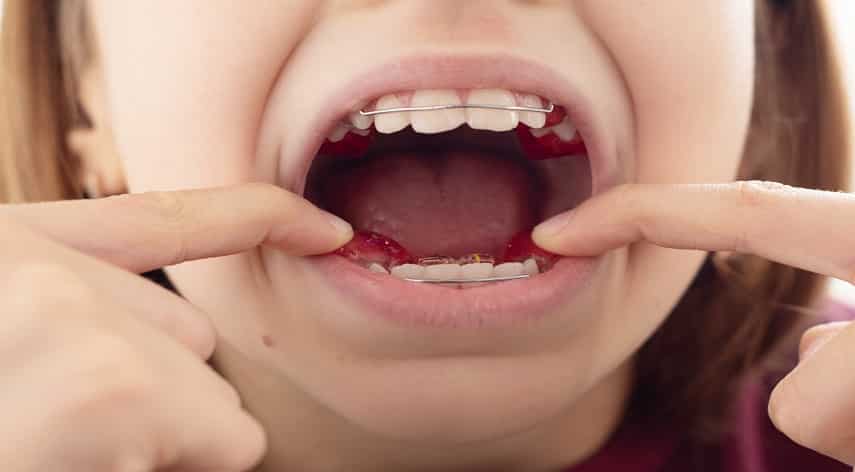 crooked teeth