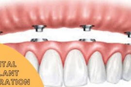 Dental Implant Restorations