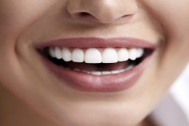 dental veneers
