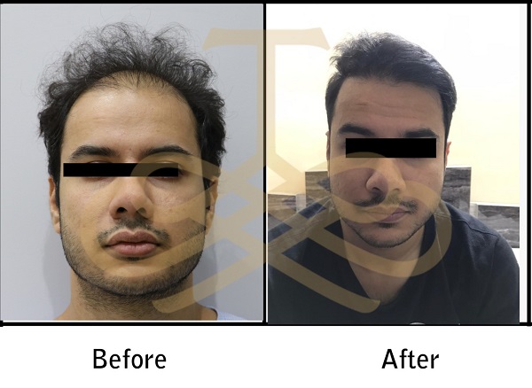 Hair Transplant Results