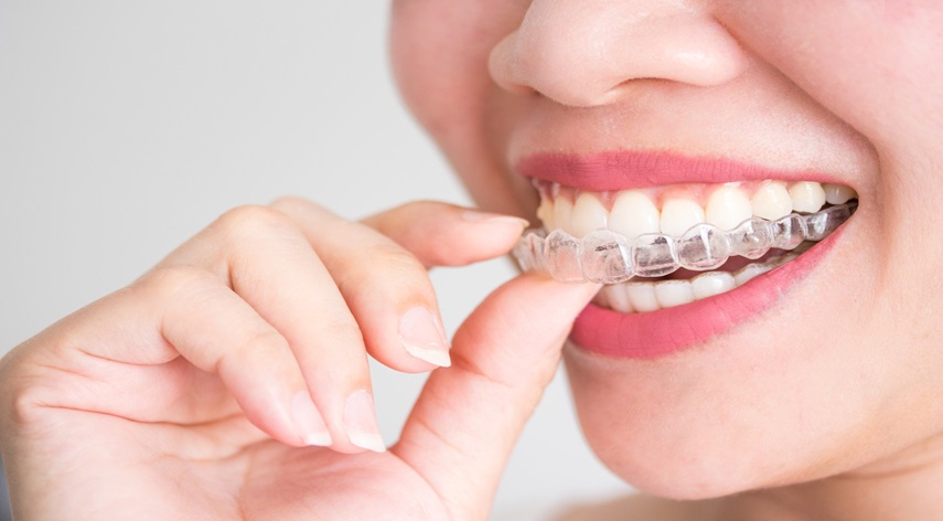 invisalign express