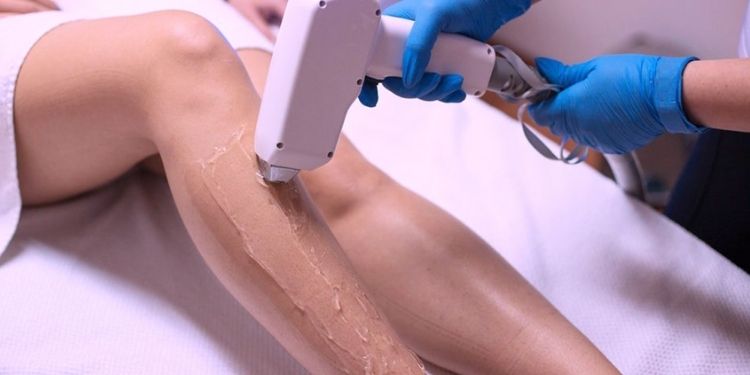 Is Laser Hair Removal Permanent?
