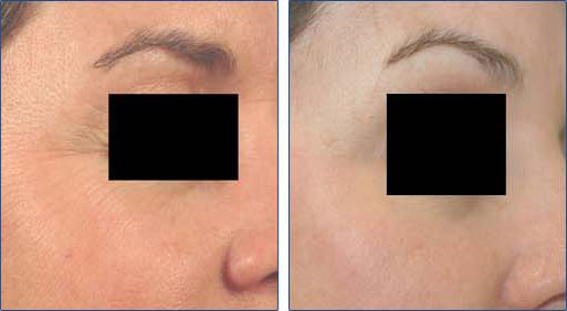 Laser skin resurfacing in torrance, 1 Laser Resurfacing for Wrinkles