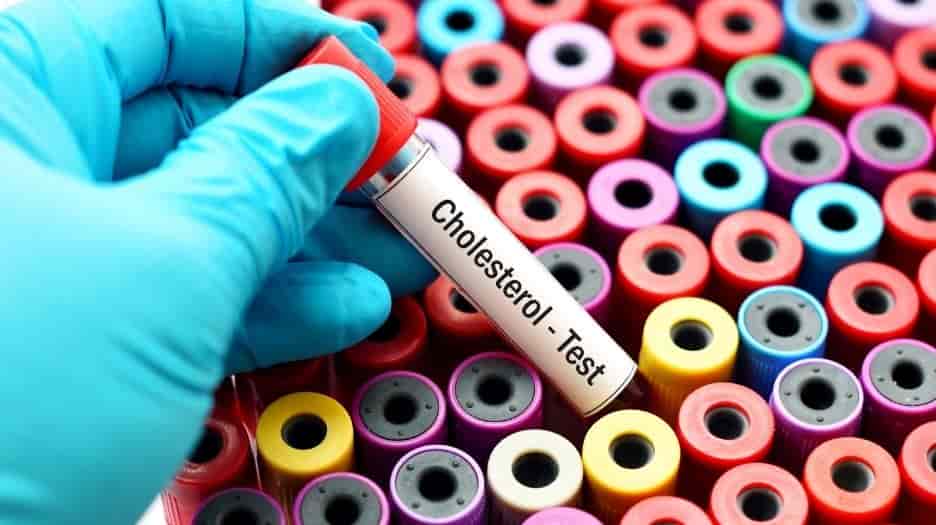 The Importance of Having Serum Cholesterol Levels Checked