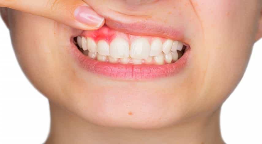 what is gingivitis